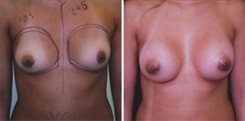 Breast Augmentation Patient Before & After Photo 1