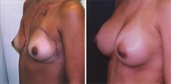 Breast Augmentation Patient Before & After Photo 1