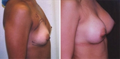 Breast Augmentation Patient Before & After Photo 1