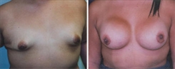 Breast Augmentation Patient Before & After Photo 1