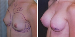 Breast Augmentation Patient Before & After Photo 1