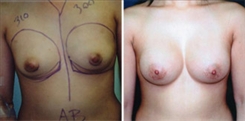 Breast Augmentation Patient Before & After Photo 1