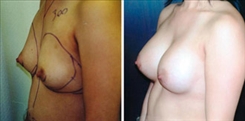 Breast Augmentation Patient Before & After Photo 1