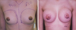 Breast Augmentation Patient Before & After Photo 1