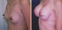 Breast Augmentation Patient Before & After Photo 1