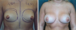 Breast Augmentation Patient Before & After Photo 1