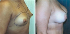 Breast Augmentation Patient Before & After Photo 1