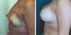 Breast Augmentation Patient Before & After Photo 1