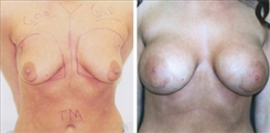 Breast Augmentation Patient Before & After Photo 1