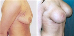 Breast Augmentation Patient Before & After Photo 1