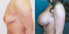 Breast Augmentation Patient Before & After Photo 1