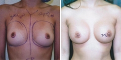 Breast Augmentation Patient Before & After Photo 1