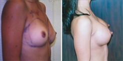 Breast Augmentation Patient Before & After Photo 1