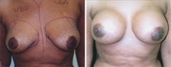 Breast Augmentation Patient Before & After Photo 1