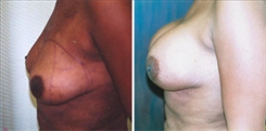 Breast Augmentation Patient Before & After Photo 1