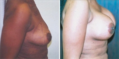 Breast Augmentation Patient Before & After Photo 1