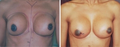 Breast Augmentation Patient Before & After Photo 1