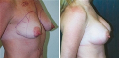 Breast Augmentation Patient Before & After Photo 1