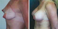 Breast Augmentation Patient Before & After Photo 1