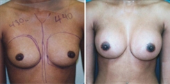 Breast Augmentation Patient Before & After Photo 1