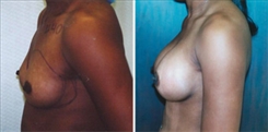 Breast Augmentation Patient Before & After Photo 1