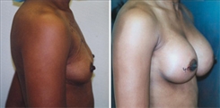 Breast Augmentation Patient Before & After Photo 1