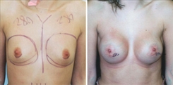 Breast Augmentation Patient Before & After Photo 1