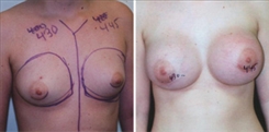 Breast Augmentation Patient Before & After Photo 1