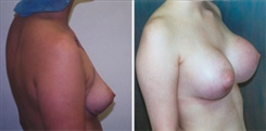 Breast Augmentation Patient Before & After Photo 1