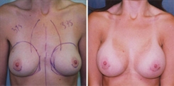 Breast Augmentation Patient Before & After Photo 1