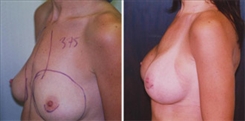 Breast Augmentation Patient Before & After Photo 1