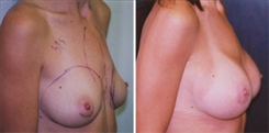 Breast Augmentation Patient Before & After Photo 1