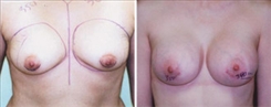 Breast Augmentation Patient Before & After Photo 1