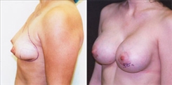 Breast Augmentation Patient Before & After Photo 1