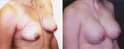 Breast Augmentation Patient Before & After Photo 1