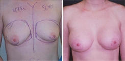 Breast Augmentation Patient Before & After Photo 1