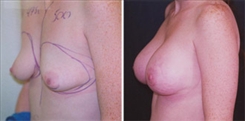 Breast Augmentation Patient Before & After Photo 1