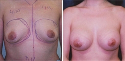 Breast Augmentation Patient Before & After Photo 1