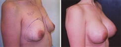 Breast Augmentation Patient Before & After Photo 1