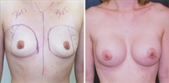 Breast Augmentation Patient Before & After Photo 1