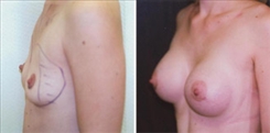 Breast Augmentation Patient Before & After Photo 1