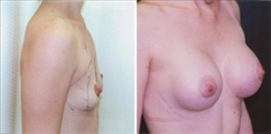 Breast Augmentation Patient Before & After Photo 1