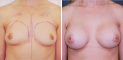 Breast Augmentation Patient Before & After Photo 1