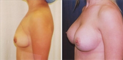 Breast Augmentation Patient Before & After Photo 1