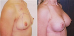 Breast Augmentation Patient Before & After Photo 1