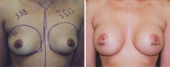 Breast Augmentation Patient Before & After Photo 1