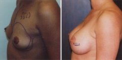 Breast Augmentation Patient Before & After Photo 1