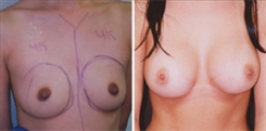 Breast Augmentation Patient Before & After Photo 1