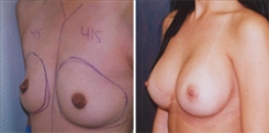 Breast Augmentation Patient Before & After Photo 1