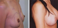 Breast Augmentation Patient Before & After Photo 1